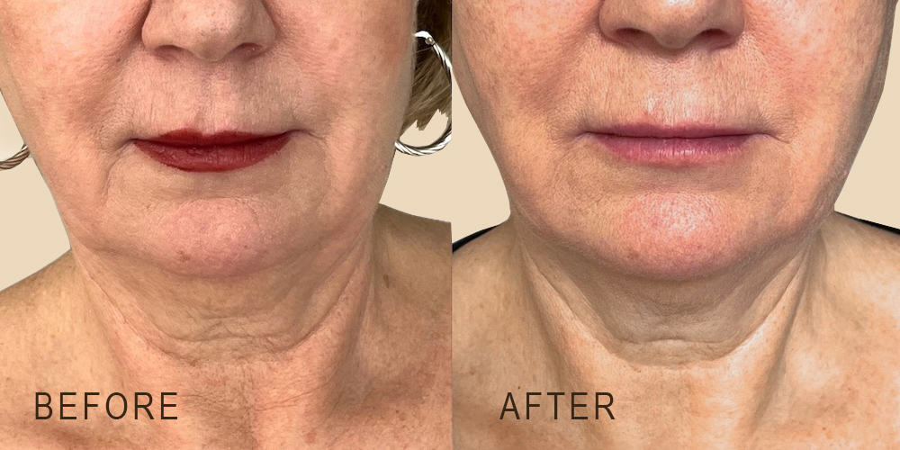 Before & After Results